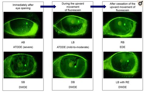 tear free clinical ocular testing|eye test for dry eyes.